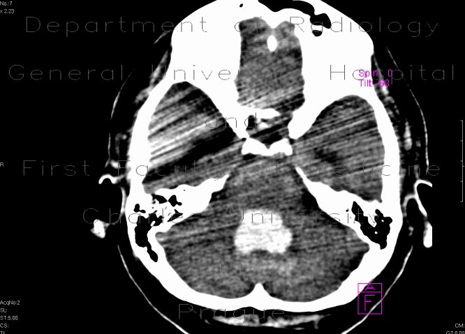 Intracerebral hemorhage, hemocephalus, tamponaded fourth ventricle