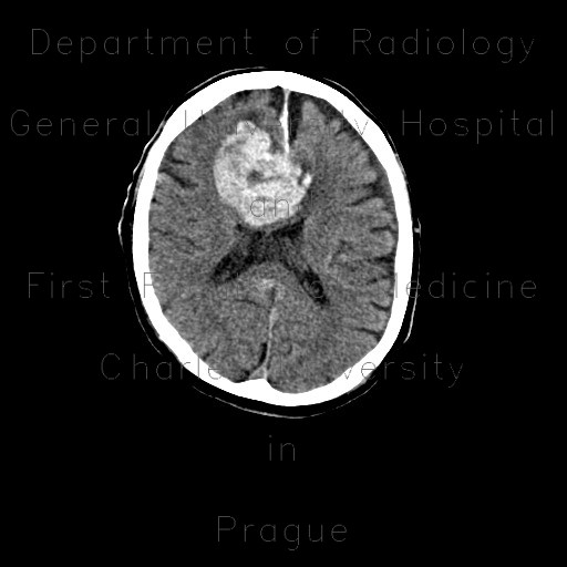 Intracerebral hemorrhage, semioval center