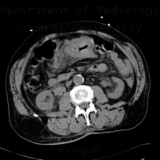 Intramural bleeding into transverse colon