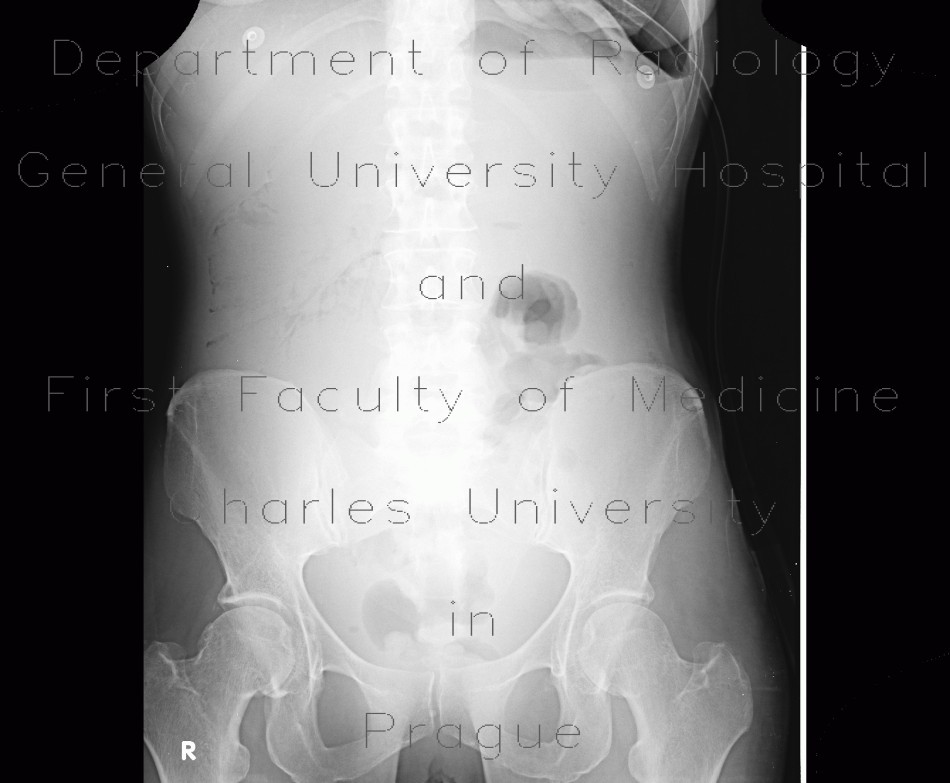 Intramural gas in bowel wall on abdominal radiograph