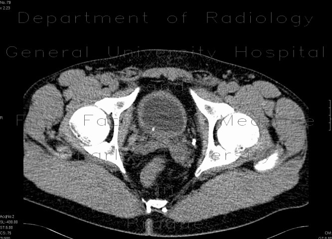 Radiology image - Intramural ureterolithiasis: Abdomen, Urinary tract: CT - Computed tomography