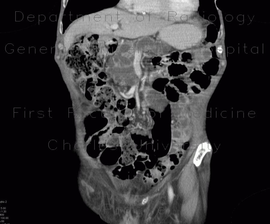 Radiology image - Intrapapillary mucinous neoplasm of pancreas, IPMN, central IPMN: Abdomen, Pancreas: CT - Computed tomography