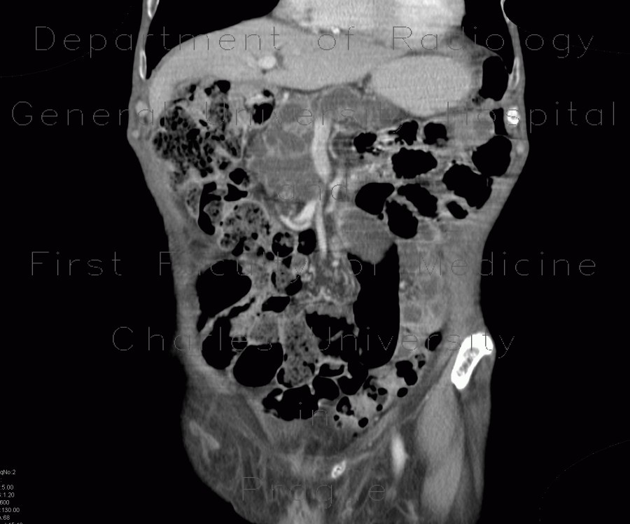 Intrapapillary mucinous neoplasm of pancreas, IPMN, central IPMN