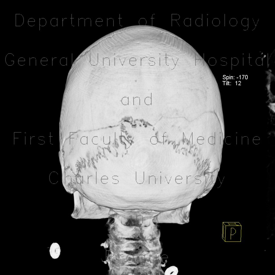 Intraparietal suture, accessory suture