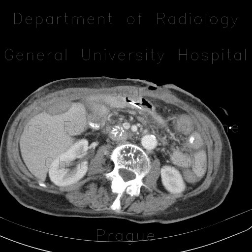 Radiology image - Intraperitoneal hemorrhage, mimic of carcinosis, subcapsular hematoma of the liver: Abdomen, Liver, Peritoneal cavity: CT - Computed tomography