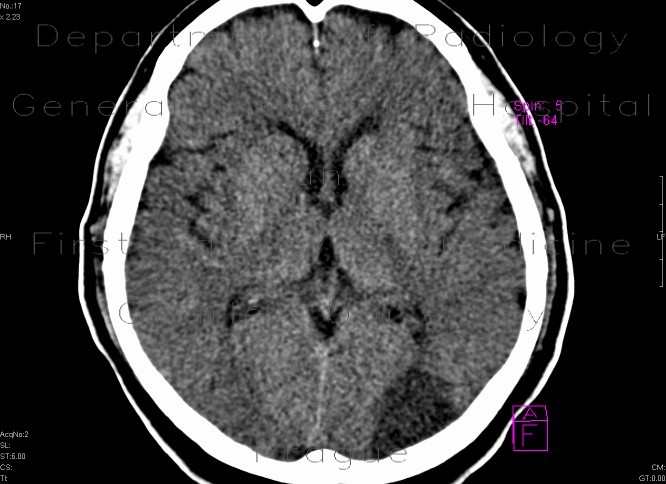 Ischemic focus in brain