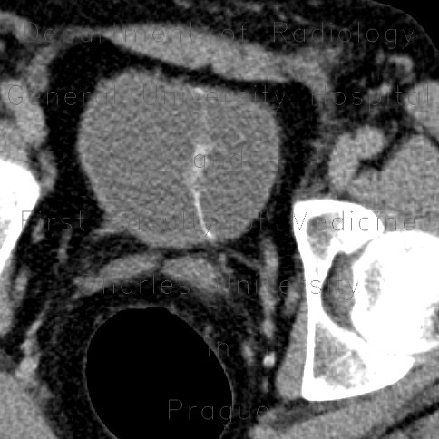 Jet of opacified urine in urinary bladder