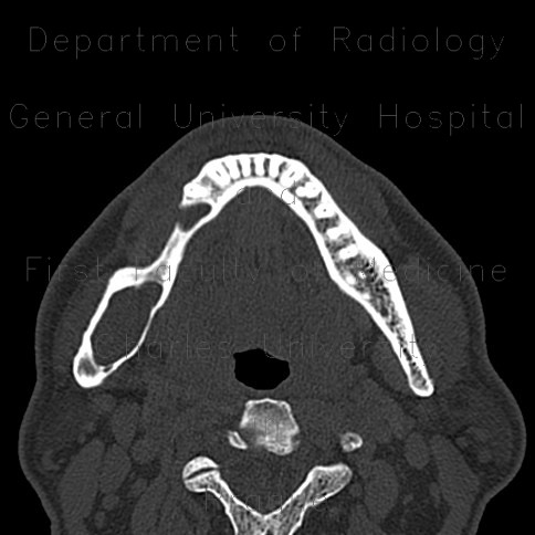 Radiology image - Keratocyst of mandible: Head and Neck, Bone, Oral cavity: CT - Computed tomography
