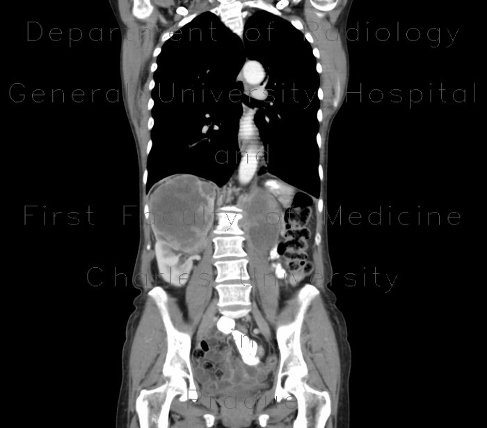 Radiology image - Kidney metastasis of lung carcinoma: Abdomen, Kidney and adrenals: CT - Computed tomography
