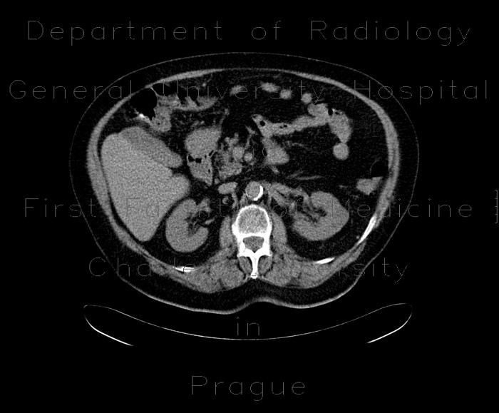 Radiology image - Kidney tumour, RFA: Abdomen, Kidney and adrenals: CT - Computed tomography
