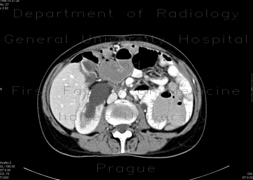 Krukenberg tumor, ovarian metastases from stomach tumour, hydronephrosis