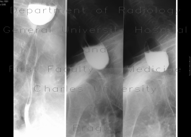 Large Zenker's diverticulum
