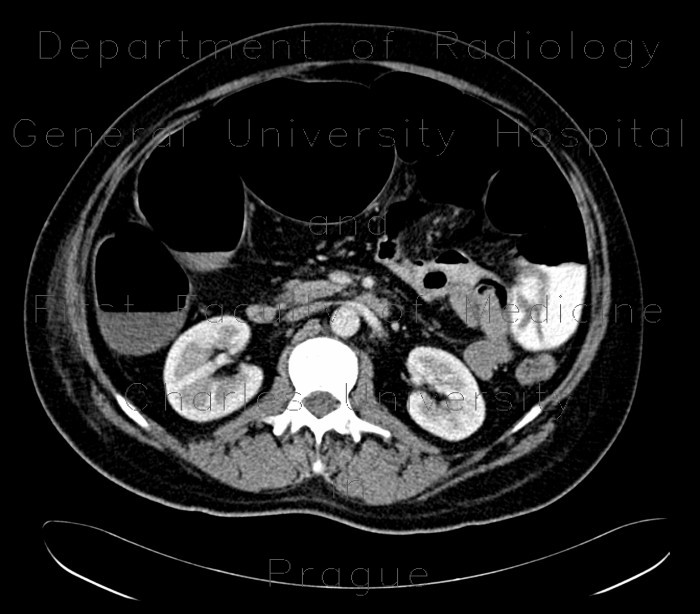 Large bowel ileus