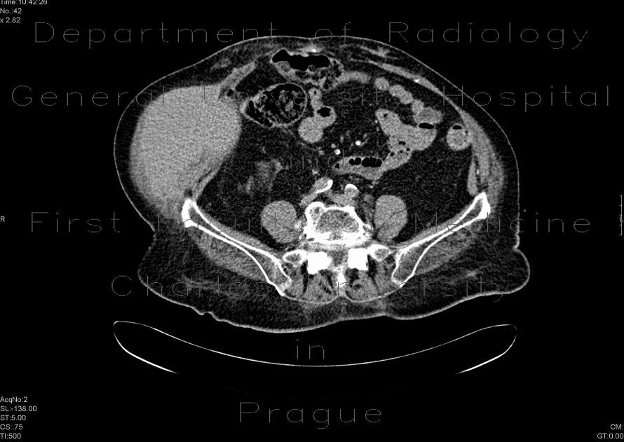Radiology image - Large hematoma of the abdominal wall: Abdomen, Soft tissue: CT - Computed tomography