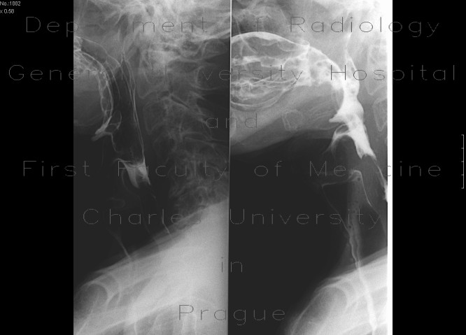 Radiology image - Laryngeal dysphagia: Thorax, Lung, Oesophagus: RF - Fluoroscopy