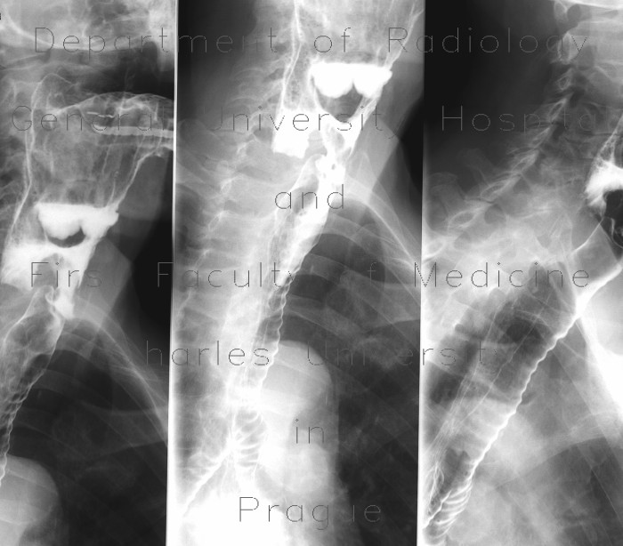 Radiology image - Laryngeal dysphagia, aspiration: Head and Neck, Thorax, Lung, Oesophagus: RF - Fluoroscopy