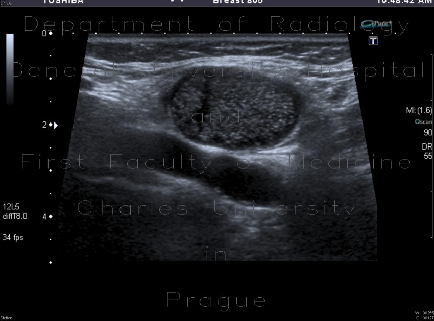 Radiology image - Lateral cervical cyst, complicated: Head and Neck, Soft tissue: US - Ultrasound