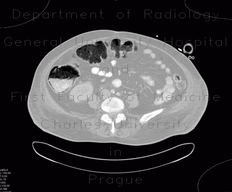 Layering of gas in the large bowel