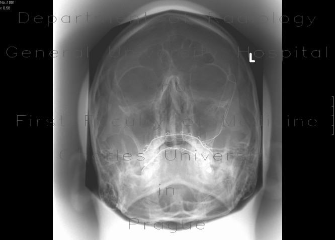 Le Fort II, fracture of facial skeleton