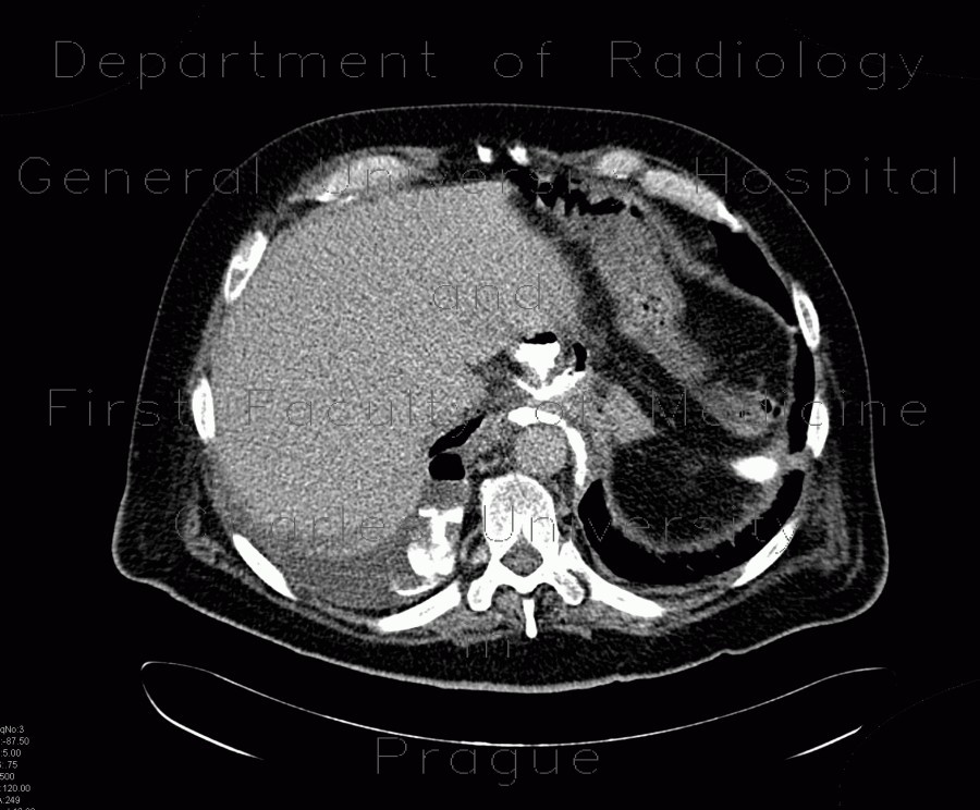 Radiology image - Leak of anastomosis of esophagus in pleural cavity, gastroesophageal anastomosis: Thorax, Mediastinum and pleural cavity, Oesophagus: CT - Computed tomography
