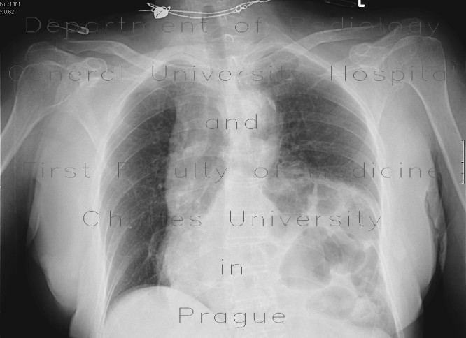 Left diaphraghmatic hernia