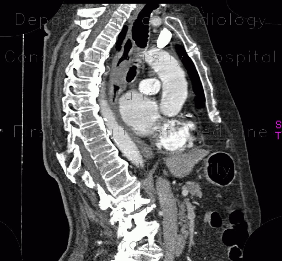 Radiology image - Leiomyoma of esophagus: Thorax, Oesophagus: CT - Computed tomography