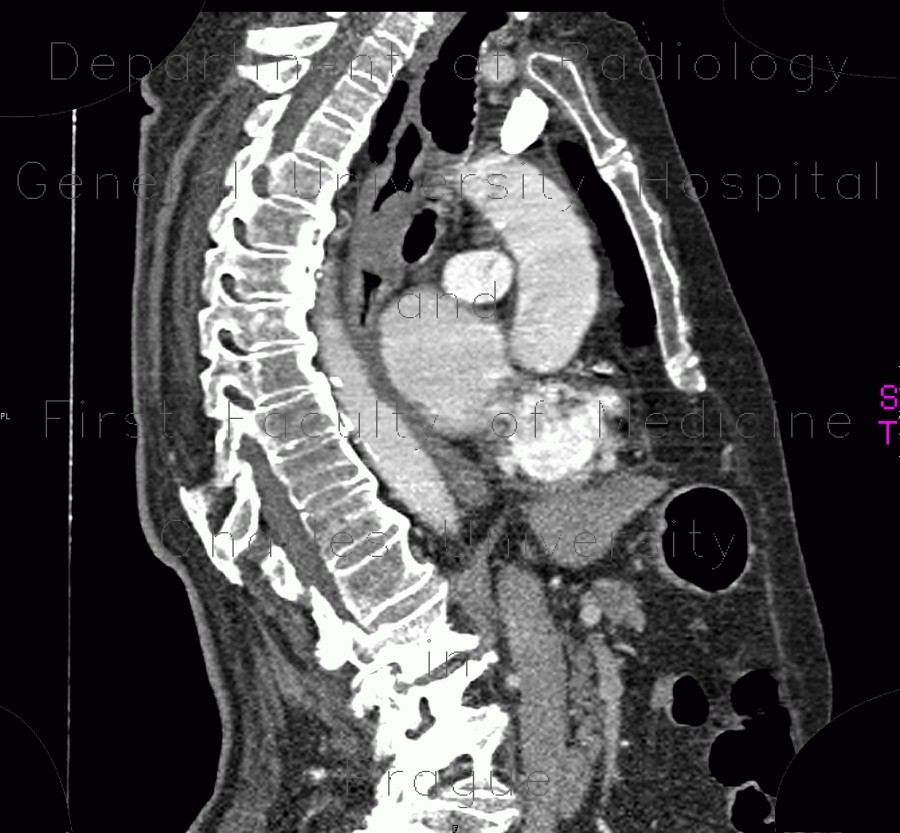 Leiomyoma of esophagus