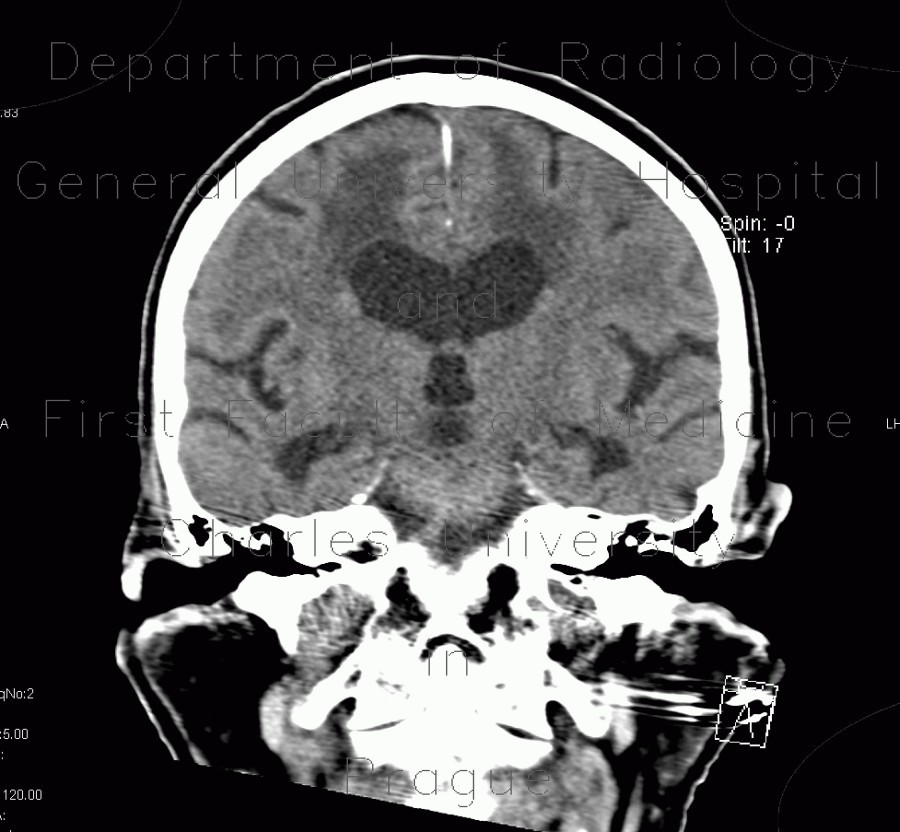 Radiology image - Leukoaraiosis, atherosclerotic encephalopathy, periventricular atrophy, hydrocephalus e vacuo: Brain, Brain: CT - Computed tomography