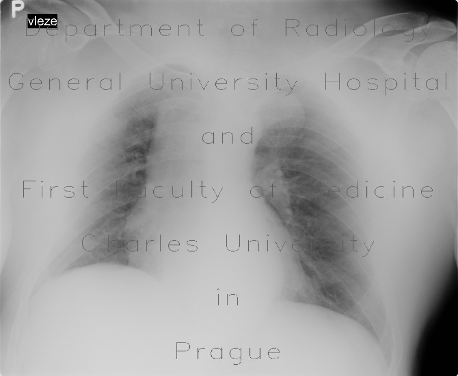 Lipofibroma, subcutaneous