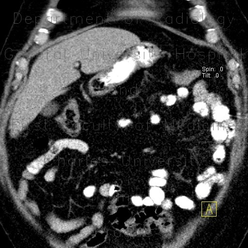 Lipoma in duodenum, small