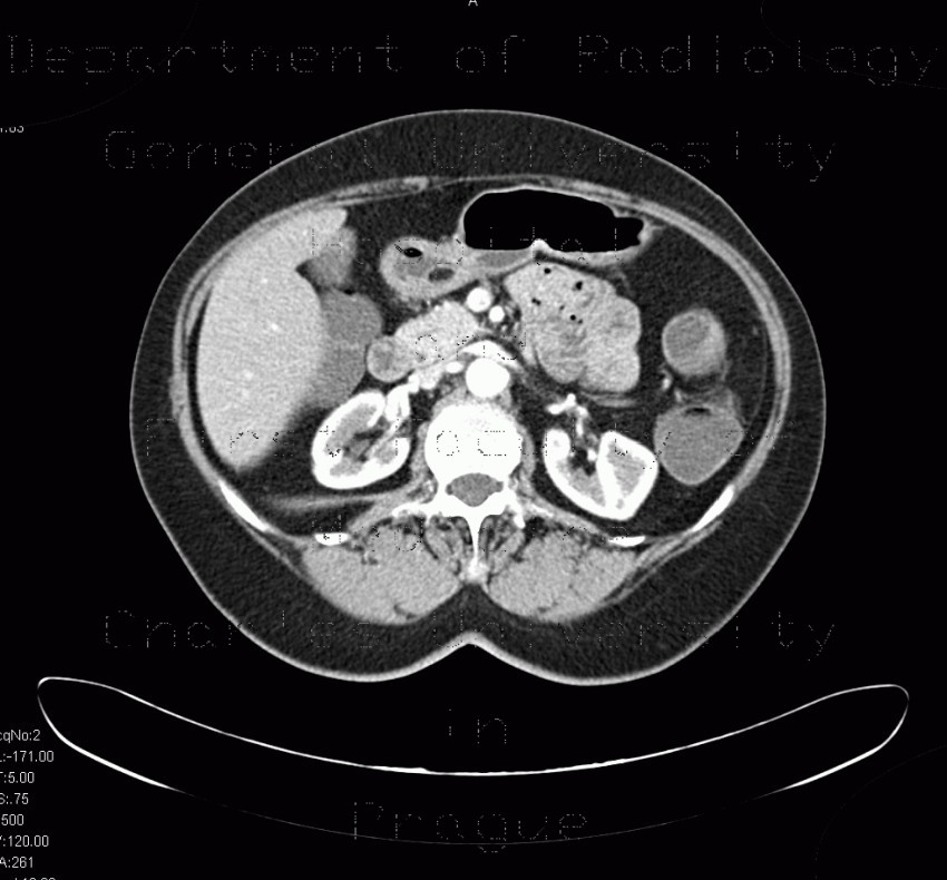 Lipoma of duodenum