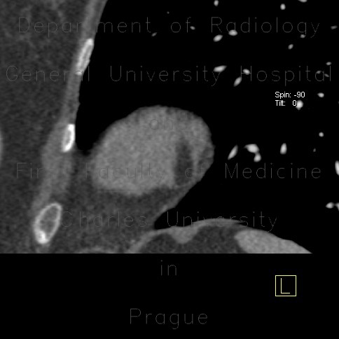 Lipoma of left ventricle