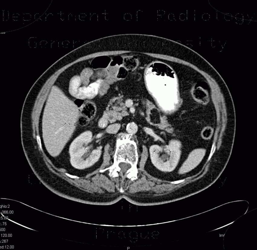 Radiology image - Lipoma of pancreas: Abdomen, Pancreas: CT - Computed tomography