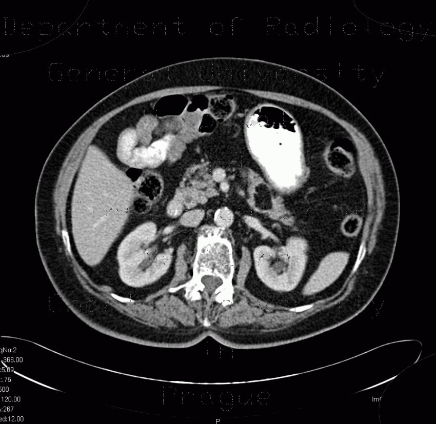 Lipoma of pancreas