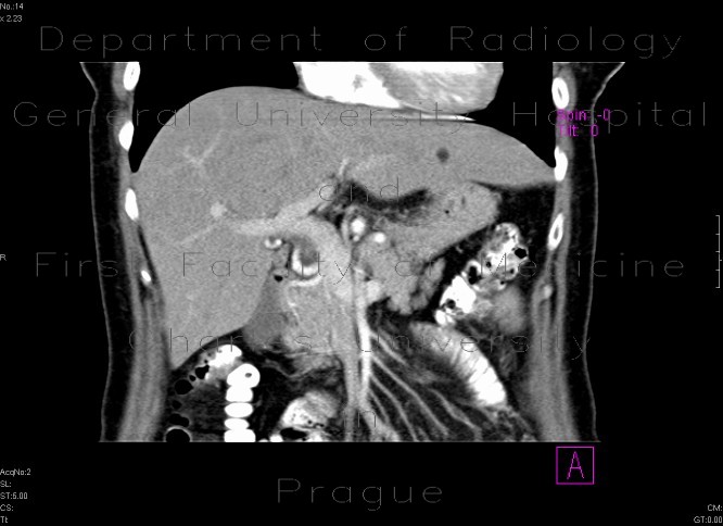 Lipoma of the liver