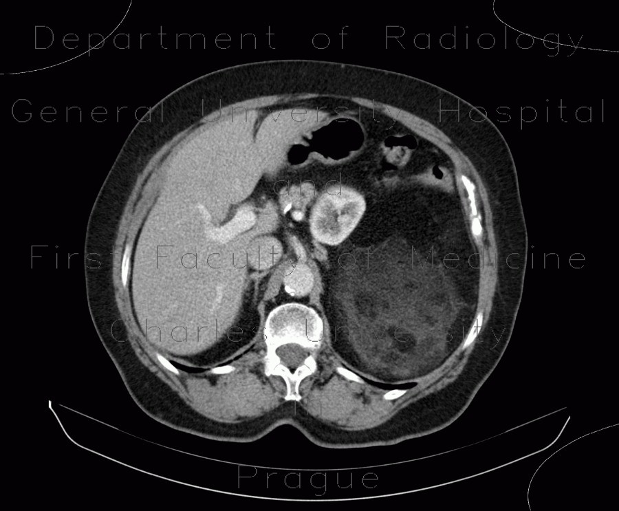 Radiology image - Liposarcoma, retroperitoneal: Abdomen, Retroperitoneum, pelvis: CT - Computed tomography