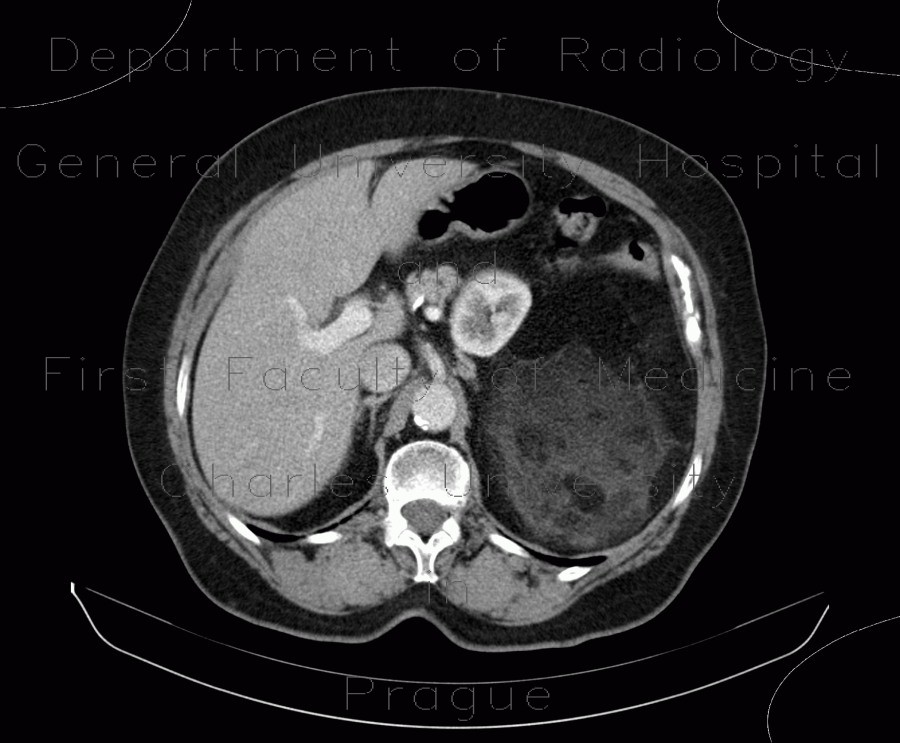 Liposarcoma, retroperitoneal