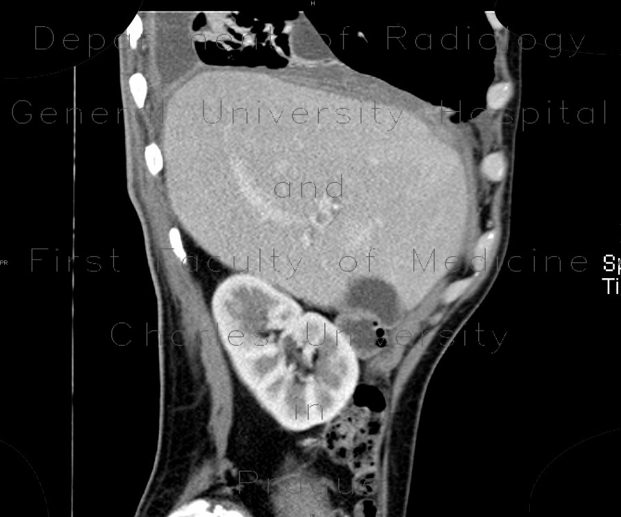 Liver abscess, large, punction, pneumothorax