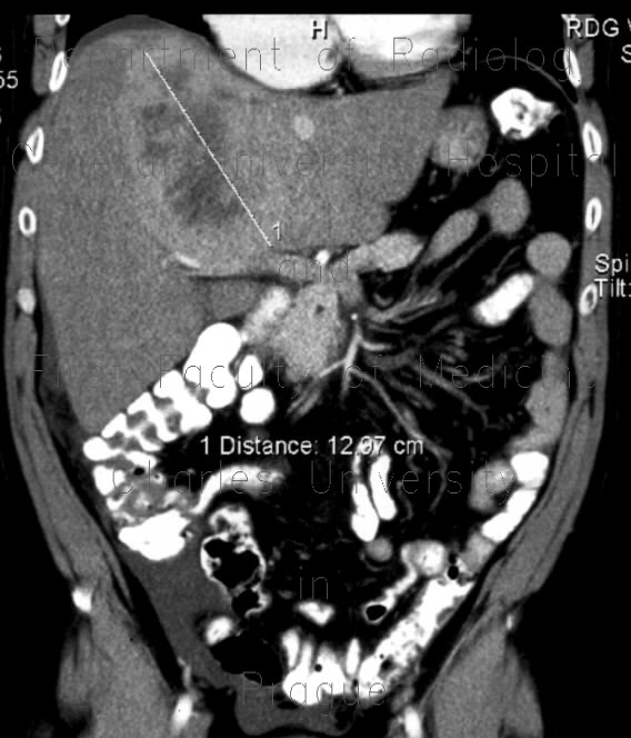 Radiology image - Liver carcinoid: Abdomen, Liver: CT - Computed tomography