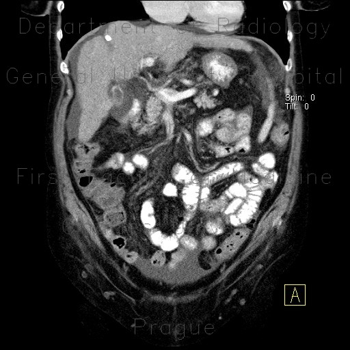 Radiology image - Liver cirrhosis: Abdomen, Liver: CT - Computed tomography