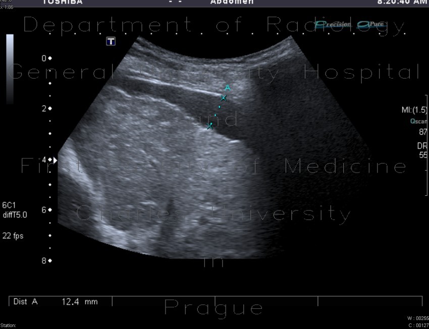 Liver cirrhosis