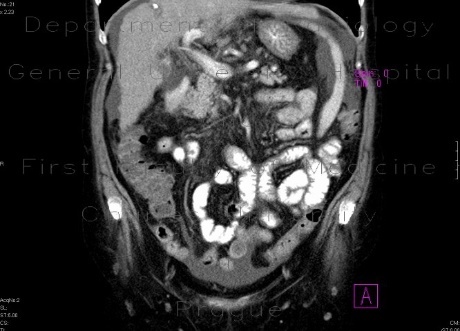 Liver cirrhosis