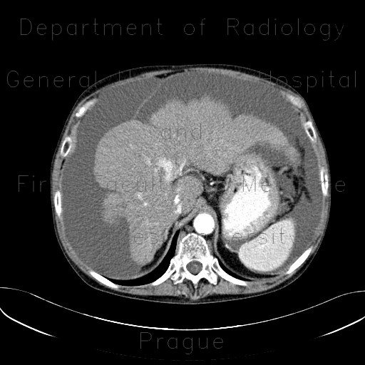 Radiology image - Liver cirrhosis, macronodular, ascites, massive: Abdomen, Liver, Peritoneal cavity: CT - Computed tomography