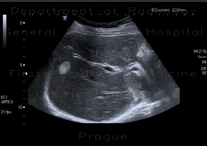 Radiology image - Liver hemangioma: Abdomen, Liver: US - Ultrasound