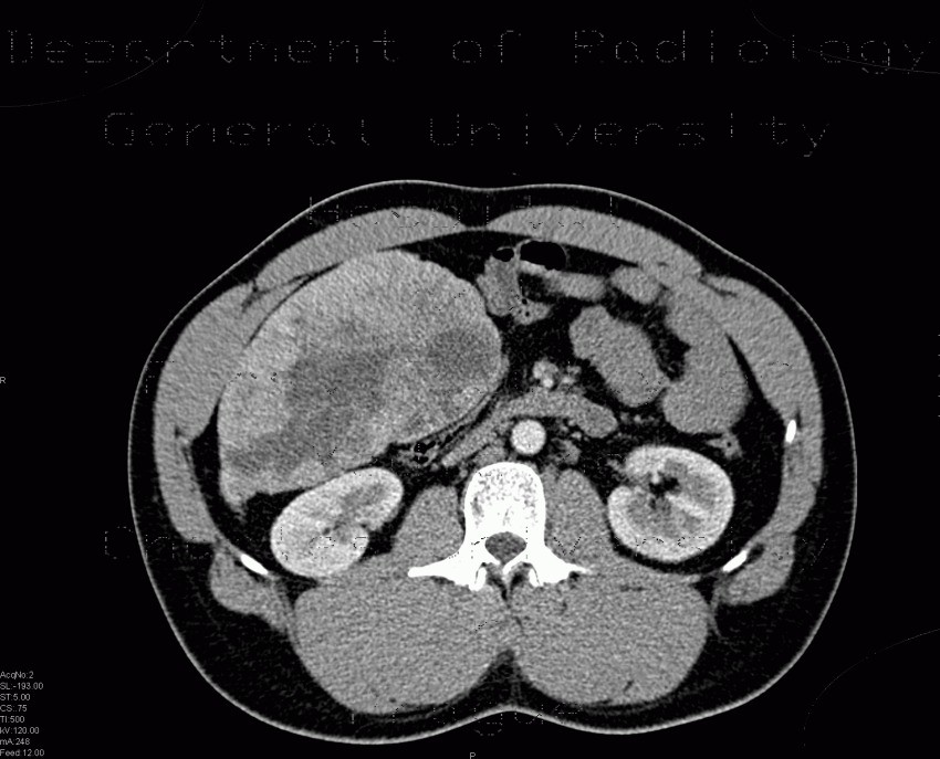 Radiology image - Liver hemangioma, gigantic: Abdomen, Liver: CT - Computed tomography