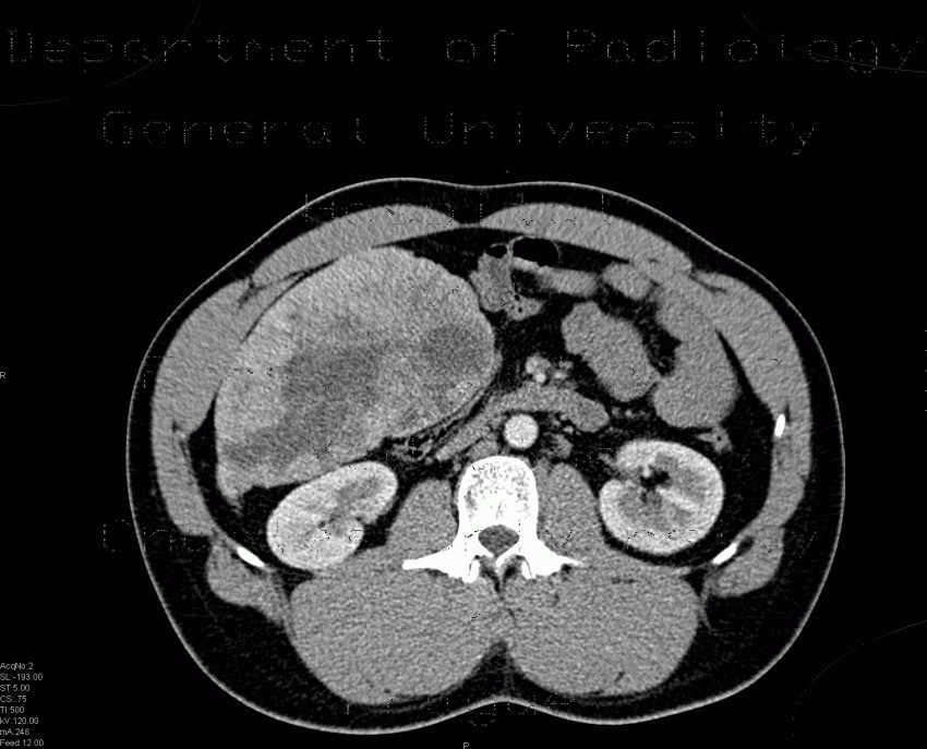 Liver hemangioma, gigantic