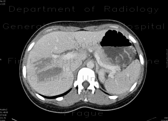 Radiology image - Liver hematoma: Abdomen, Liver: CT - Computed tomography