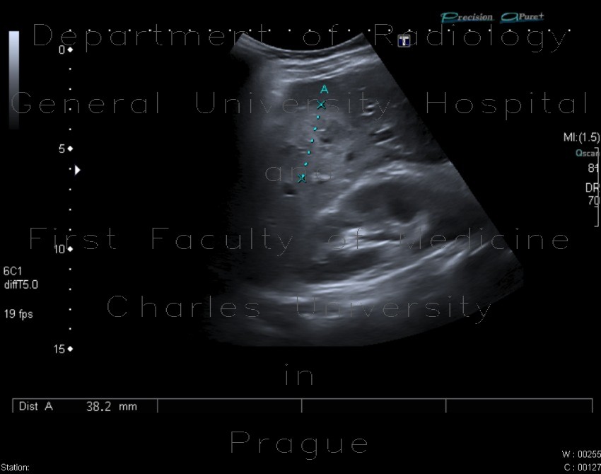 Radiology image - Liver hematoma: Abdomen, Liver: US - Ultrasound