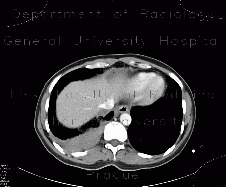 Liver hematoma, hemothorax, stab wound