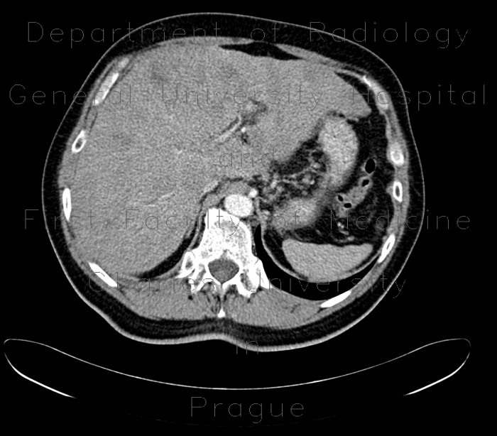 Liver metastases